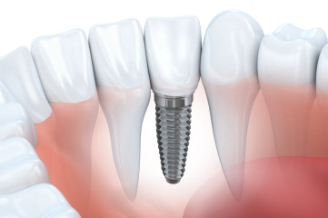 Dental Implants